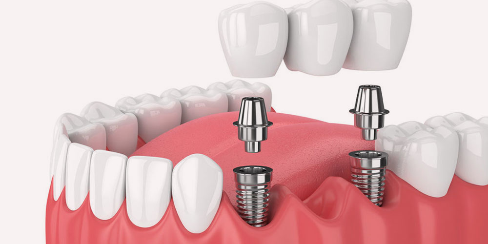 Dental Implant