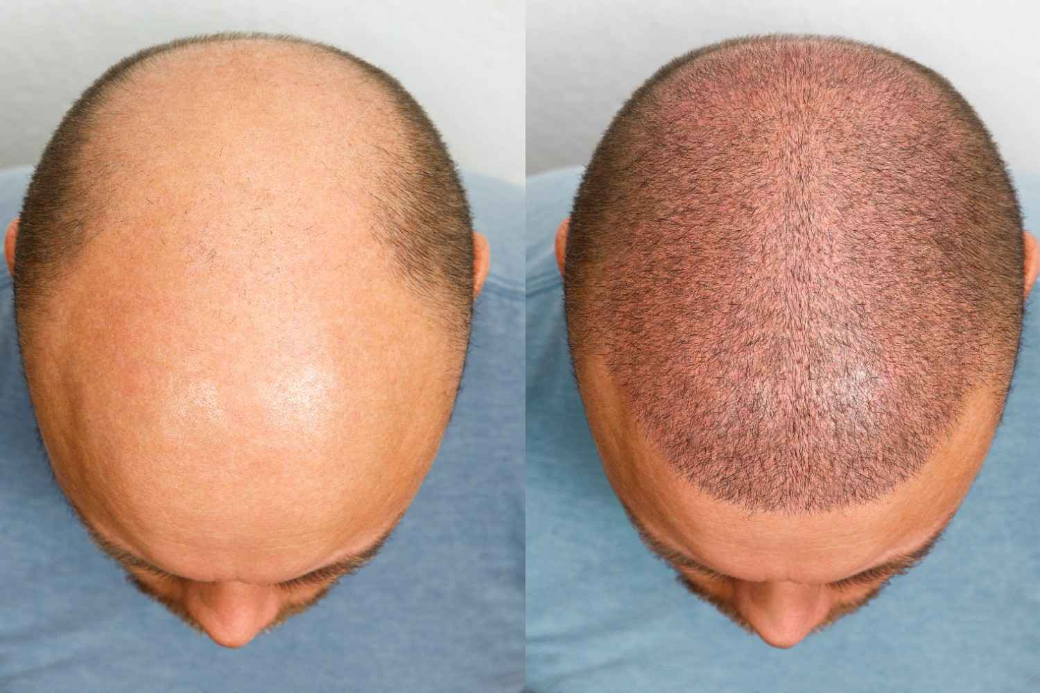 Hair_Transplant