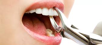 Tooth-Extraction